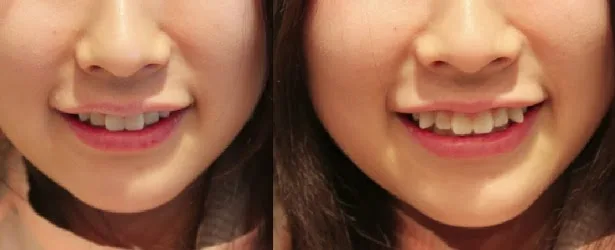 Yaeba ลักษณะฟันเขี้ยวยื่นที่สังคมญี่ปุ่นหลายคนยอมรับ ผู้หญิงยิ้มกับฟันเขี้ยวที่ยื่นเล็กน้อย ลักษณะที่ญี่ปุ่นเรียกว่า yaeba