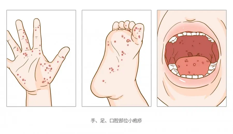 teashikuchibyou - doenças 14 Doenças mais contagiosas e as que mais matam no Japão