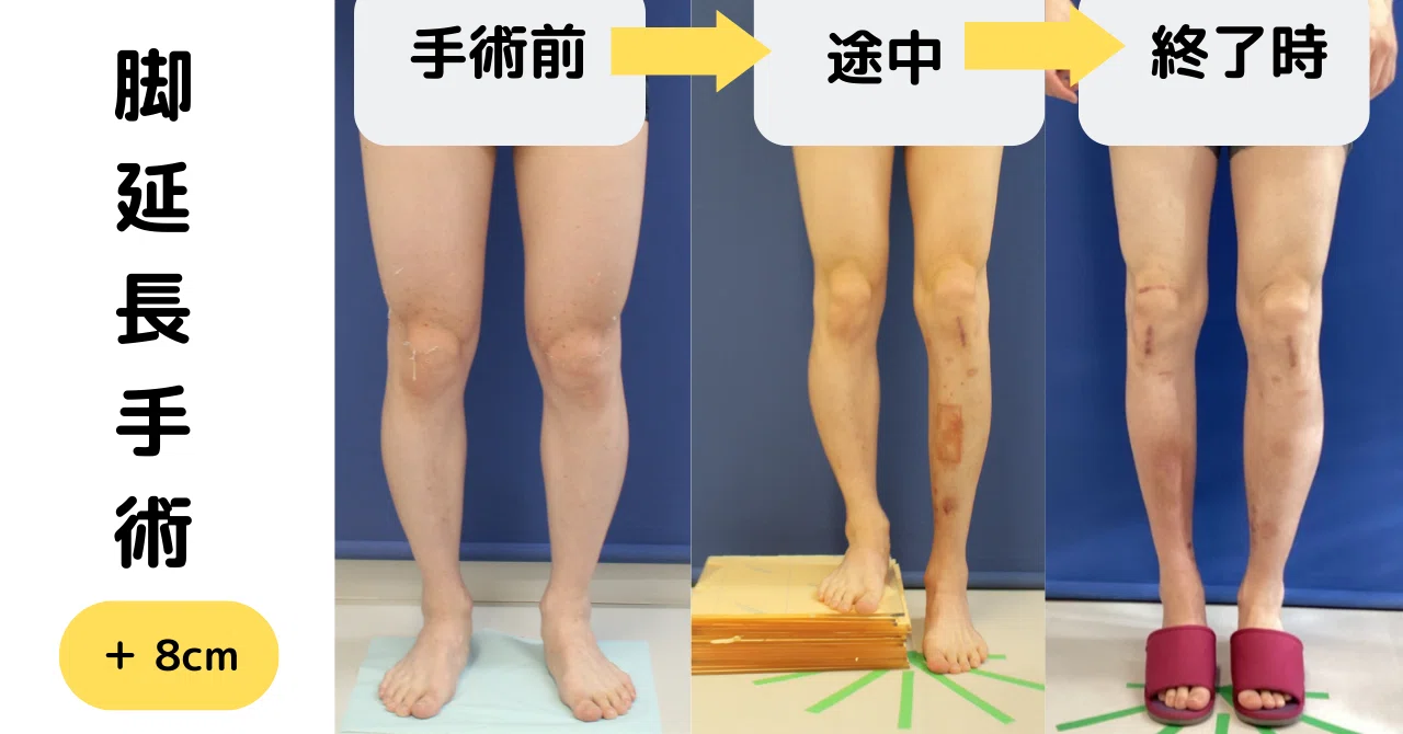 미용 다리 연장술 후 외고정 장치가 부착된 다리의 엑스레이 영상