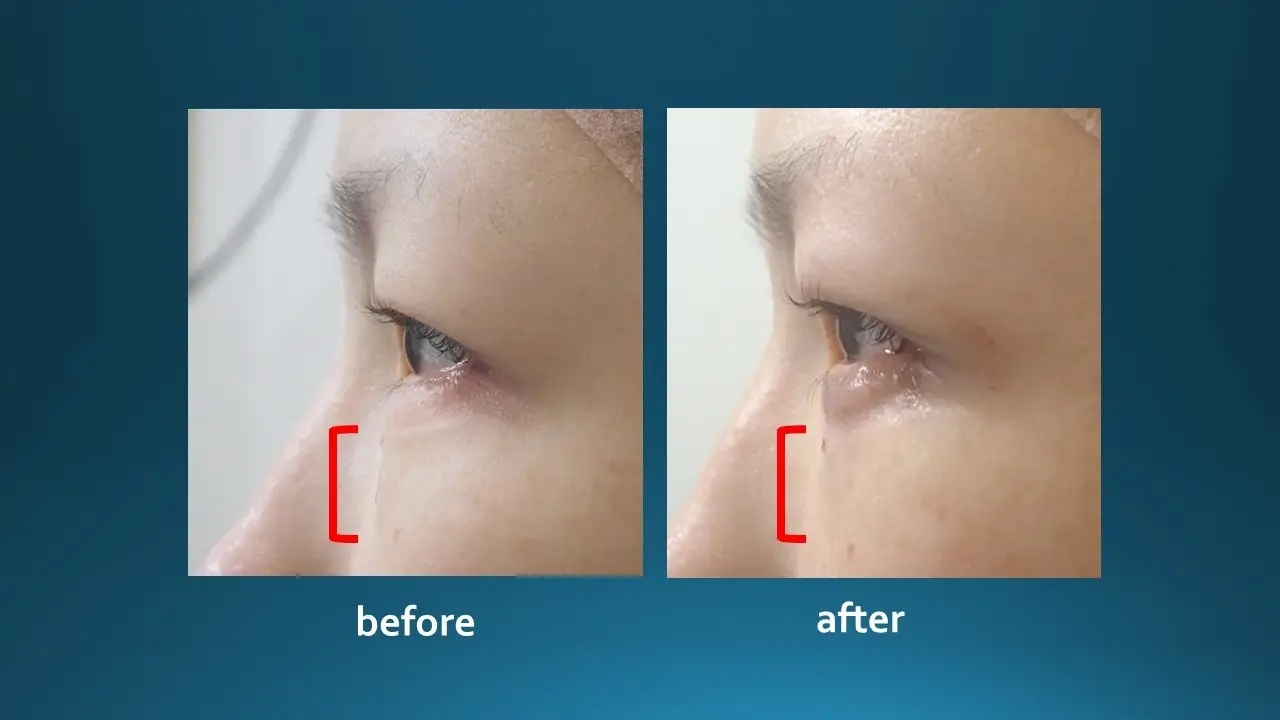 Gros plan sur des yeux après création d'une poche de larme par acide hyaluronique
